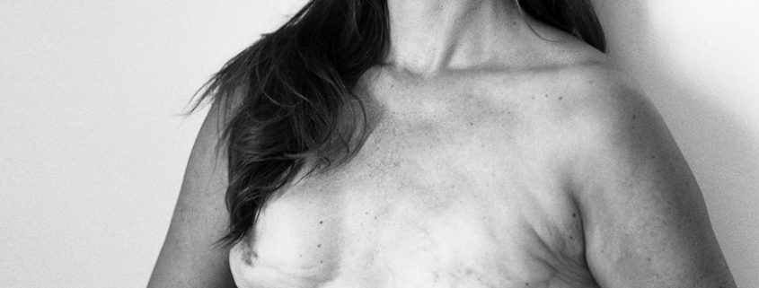 a black and white image of a woman holding a shirt against the lower half of her body and exposing her torso showing her surgery scars