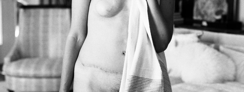 a black and white image of a woman holding a scarf against her while wearing no clothing and showing surgery scars