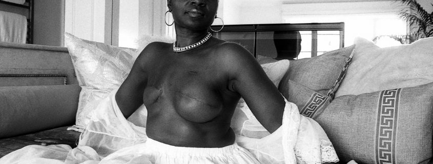 a black and white image of a woman wearing only a white skirt showing her surgery scars