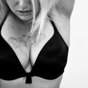 a black and white image of a woman wearing a black bra with scarring across her chest